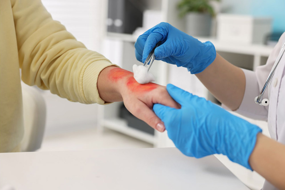 Burn Injury Burn Injury
